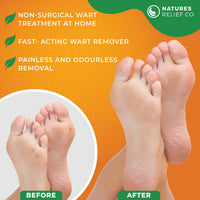 Natures Relief Co Wart Remover Serum | Suitable for Hands & Feet | Fast Acting & Effective Removal Treatment for Warts | 50ml
