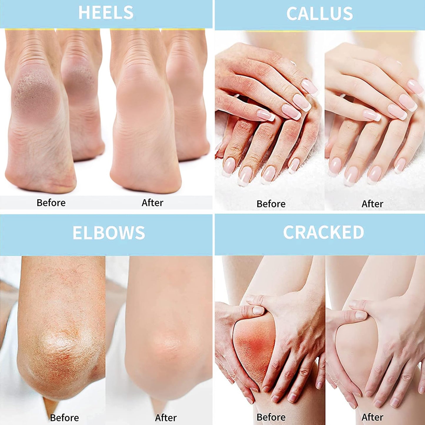 Urea 40% Foot Cream, Cracked Heel Repair Cream, 50g Callus Remover For Dry And Hard Skin Feet and Hand, Maximum Strength With 2% for Hand, Foot and Body Care