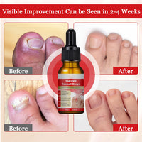 Ingrown Toenail Treatment Drop, Cuticle Care Oils for Ingrown Toenails, Trimming Toenail Softening Drops, Natural Ingrown Toenail Correction, Fungal Nail Treatment, Nail Growth Treatment, 30ml