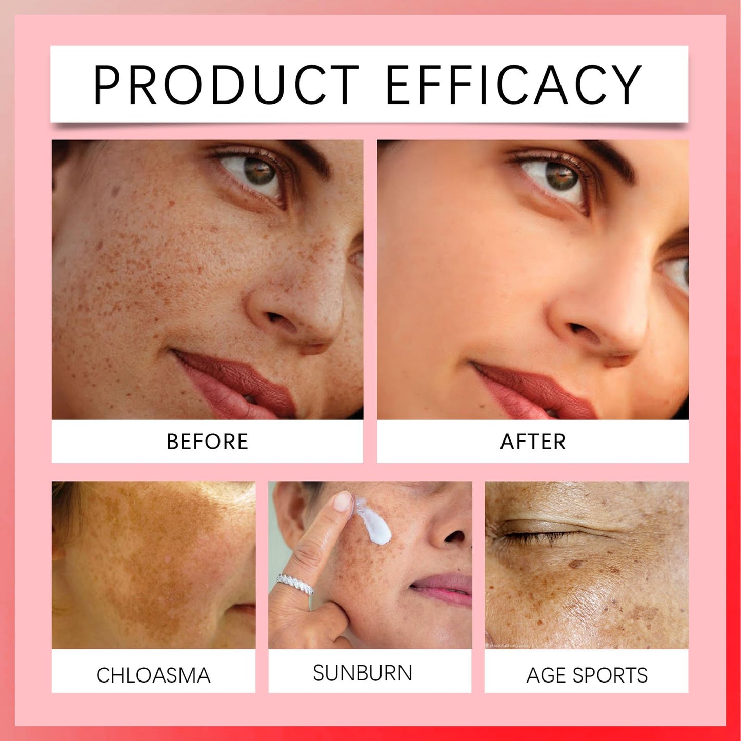 MINSHZEE Freckle Removal Cream - Removes facial dark spots, Dark Spot Remover with Niacinamide and Vitamin C, Improves dull skin (1 piece)