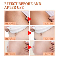 LaluluTek Stretch Mark Treatment Oil for Women - Optimal Formula for Removal of Stretch Marks, Scars, Firming & Lifting Body Care, 50ml