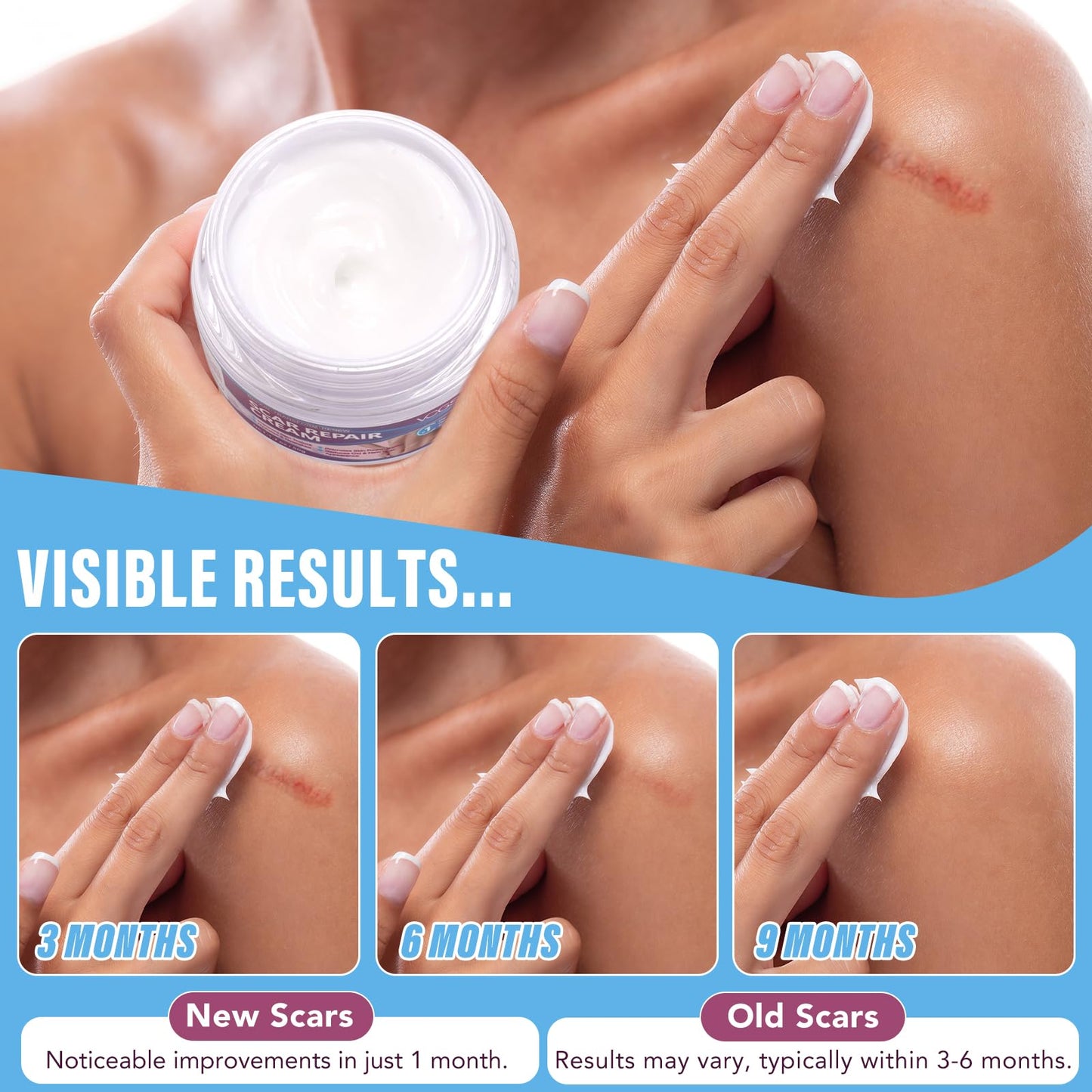 mysemgshuo 50g Advanced Scar Gel Cream, Scar Repair Cream, Scar Removal,Scar Treatment, Scar Removal Cream for C-Section, Stretch Marks, Acne, Effective for Both Old and New Scars