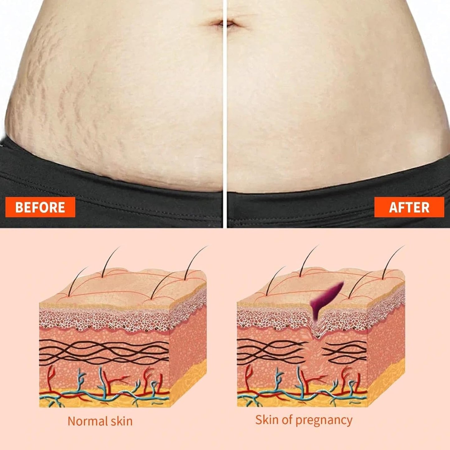 EliiSkinn Stretch-Marks, Scar Treatment Oil - Helps Reduce The Appearance Of Stretch Marks & Scars -Non-greasy Moisturizer Lotion- Improves Appearance of Stretch Marks, Scars, and Uneven Skin Tone - 125ml