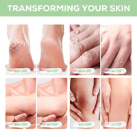 MINGYITUO Urea Foot Cream, Urea Cream 40 Percent for feet,with Hyaluronic Acid, Tea Tree and Aloe Vera,Heel Balm For Callous Removal and Soften, For dry, Cracked Feet, Heels and Hands (120g)