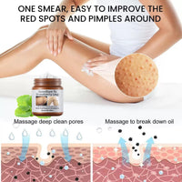 jinyue S-trawberry S-kin Treatment,Strawberry Legs Treatment,Keratosis Pilaris Cream，Keratinization & Exfoliating Body Cream for Bumpy Skin, Chicken Skin & Strawberry Spots Repair120g