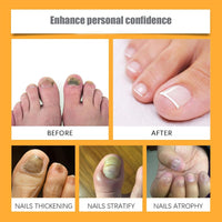 ALLILUYAA 2pcs Furzero Nail Defense Bee Venom Treatment Serum Pro, Bee Venom Nail Serum, Nail Growth and Repair Serum