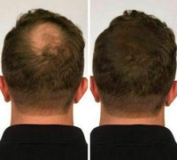 100% Natural Keratin Hair Fibre Refill For Hair Loss - Alopecia & Chemotherapy (300g, Dark Brown)