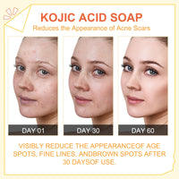 Peak Health Whitening Kojic Acid Soap Facial Bleaching Dark Spot Acne Scars Skin Brighter Lightening Detox Pigmentation Removal Reduce (Pack of 1)