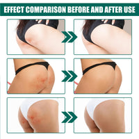 Butt Pimple Clearing Treatment Cream,Butt Acne Treatment,Butt Acne Treatment Balance Oil,Butt Acne Clearing Spot Treatment Cream,Butt Pimple Removing Cream,Butt And Thigh Acne Treatment Cream,100ml