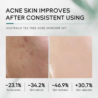 INBOLM Skin Care Sets for Women, Tea Tree Beauty Products 5 pcs Skincare for Teenage Girls Sets with Cleanser Toner Serum Essence Cream Gel Facial Care Gift Kits for Pores,Blackheads,Exfoliate