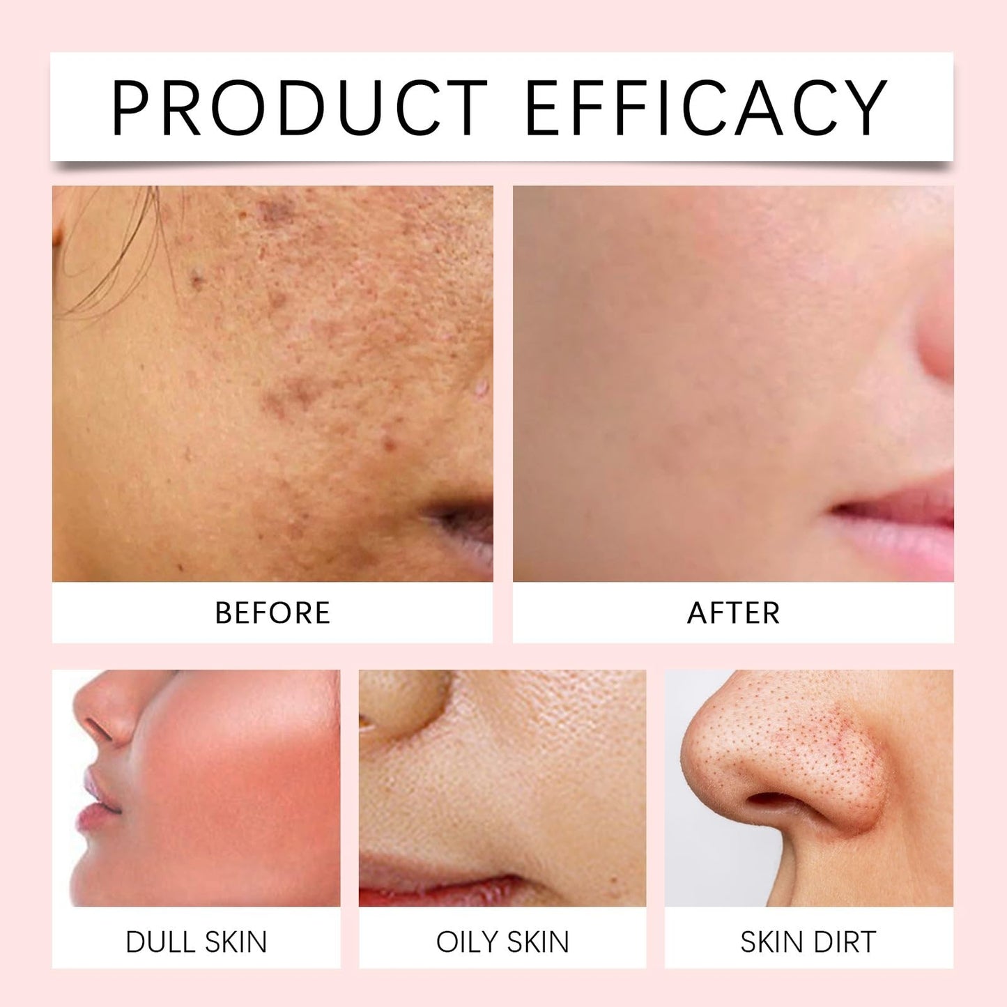 Xunzhi Acne Cream Pimple Cream for Face,Acne Treatment,Oil Control Pimple Remover Cr/eam,S/p/o/t Treatment,S/p/ot Crea/m,Acn/e Scar Treatm/ent,Anti Redness Crea/m for Face,Pim/ple Cre/am S/p/o/t Treatm/ent