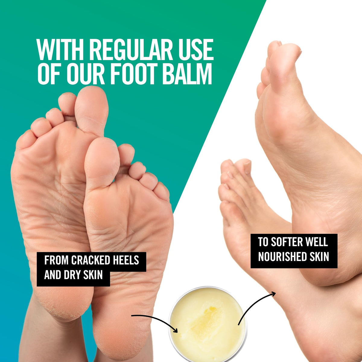 Natural Foot Balm for Cracked Heels and Dry Feet. Tea Tree and Mint. 45ml | Natural, Antibacterial and Moisturising Foot Care. Hydrating Foot and Heel Balm Treatment. By Our Tiny Bees.