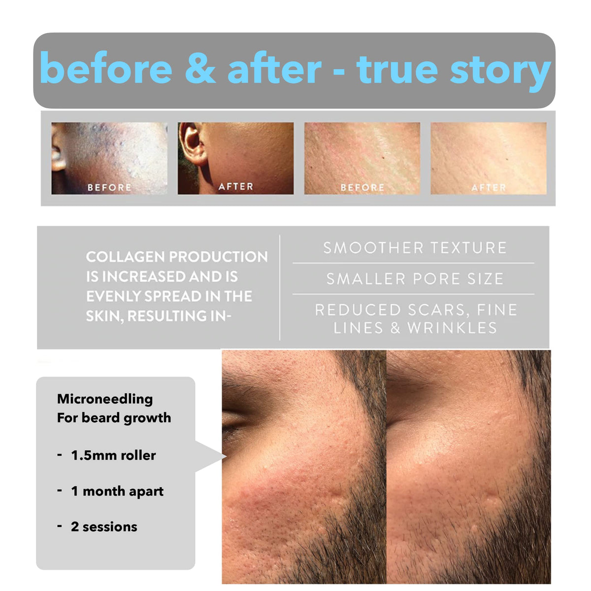 AUDUODUO Derma Roller 1.5mm SILVER Needles, ONLY for Professional Users, 540 Microneedle roller for Beard and Hair Growth, Anti-Aging Stretch Marks Scars