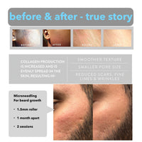 AUDUODUO Derma Roller 1.5mm SILVER Needles, ONLY for Professional Users, 540 Microneedle roller for Beard and Hair Growth, Anti-Aging Stretch Marks Scars