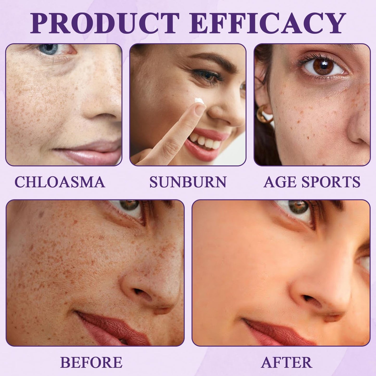 Katslyn 2 PCS Advanced Anti-Hyperpigmentation Cream, Pigmentation Removal Cream Face for Hyperpigmentation, Tightens Skin Suitable for All Skin Types