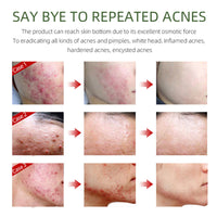 QEUTKEZS Herbal Acne Removing Cream,Professionally Remove Acne Marks,Gently Moisturize,Refreshing & Not Greasy,Improving Sensitive Skin Prone to Acne,Acne Scar Cream & Pimple Remover For All Skin Types