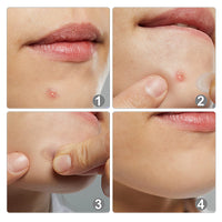 Udewo 252PCS Pimple Patches Acne Healing Patches Spot Treatment Sticker Absorbing Pimple Patches Translucent Hydrocolloid Patches Acne Stickers Invisible Spot Patches Blemish Stickers for Face and Body
