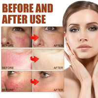 DMQ 2PCS Rosacea Face Serum,Anti Redness Face Serum,Tea Tree Anti Aging Serum for Face,Relieve Redness & Acne Mark,Natural Face Moisturizer for Sensitive Skin,Improve Skin Elasticity-Women & Men
