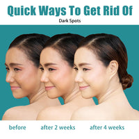 Nadiaen 2 Pcs Dark Spot Remover for Face,Age Spot Remover Hyperpigmentation Treatment-Sun Spots and Melasma Treatment Cream for Face, Pigmentation Freckle Removal Cream