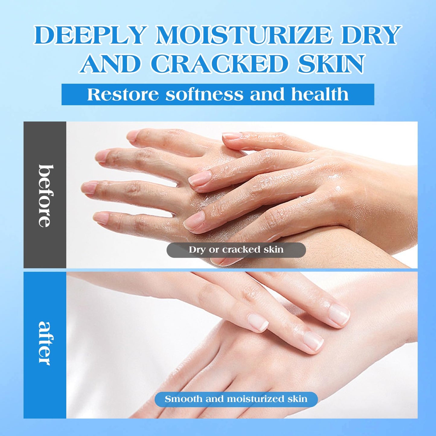 HOPHAT 42% Urea Cream with 2% Salicylic Acid & 5% Vitamin E - Intensive Moisturizer Foot & Hand Repair Cream for Dry, Cracked Skin - 150g