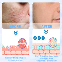 Bettinay 5PCS Micro Infusion Facial System for Lips, Serum Beauty Kit for Repair Skin Deep Nourishment All Skin Types