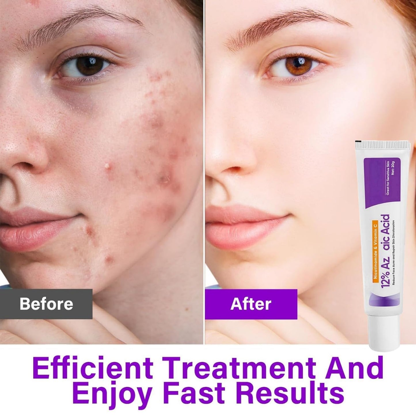 SingHao 2pcs Spot Cream,Acid 12% Facial Serum Cream,Azela-Ic Acid Face Cream,Night Cream Face Moisturiser,12% Ac/id Pimple Crea/m Spot Treatment,Azela-Ic Aci/d Serum for Face,Acne Treatment for Spo/t Prone
