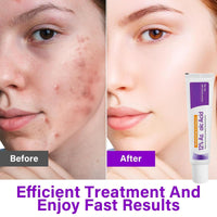 SingHao 2pcs Spot Cream,Acid 12% Facial Serum Cream,Azela-Ic Acid Face Cream,Night Cream Face Moisturiser,12% Ac/id Pimple Crea/m Spot Treatment,Azela-Ic Aci/d Serum for Face,Acne Treatment for Spo/t Prone