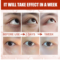 IZBEAUVO 2PCS Milia Remover Serum, Milia Remover for Face Fast-Acting Milia Spot Remover, Anti-Aging Eye Serum for Dark Circles and Puffiness, Reduces Wrinkles Saggy Skin & Puffy Eyes