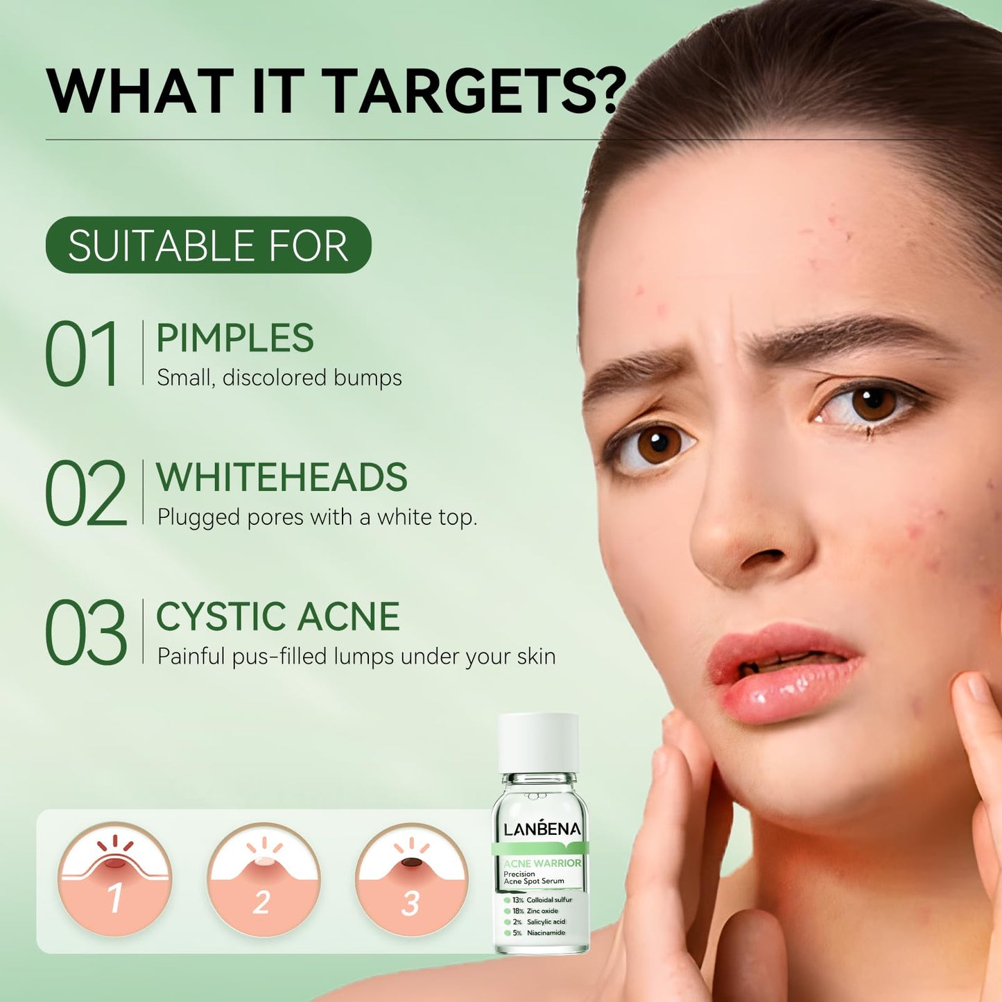 LANBENA Precision Acne Spot Serum, Acne Drying Lotion, Overnight Acne Treatment For Face, Dry Out Pimples, Blemishes, Zits And Clean Pores, 0.42 Fl Oz (Pack of 1)