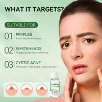 LANBENA Precision Acne Spot Serum, Acne Drying Lotion, Overnight Acne Treatment For Face, Dry Out Pimples, Blemishes, Zits And Clean Pores, 0.42 Fl Oz (Pack of 1)