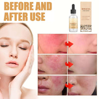 KKwoter Rosacea Face Serum Combo - Anti-Blushing & Anti-Aging with Tea Tree Oil. Moisturizes Sensitive Skin, slows down Zit & Blush Marks, Improves Elasticity. For Women & Men