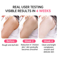 Grospe Skin Exfoliating Repair Cream, Chicken Skin Care Cream, Strawberry Legs Treatment Body Cream, Hydrating Moisturising Refreshing Skin Fragrance Repair Body Lotion 50g