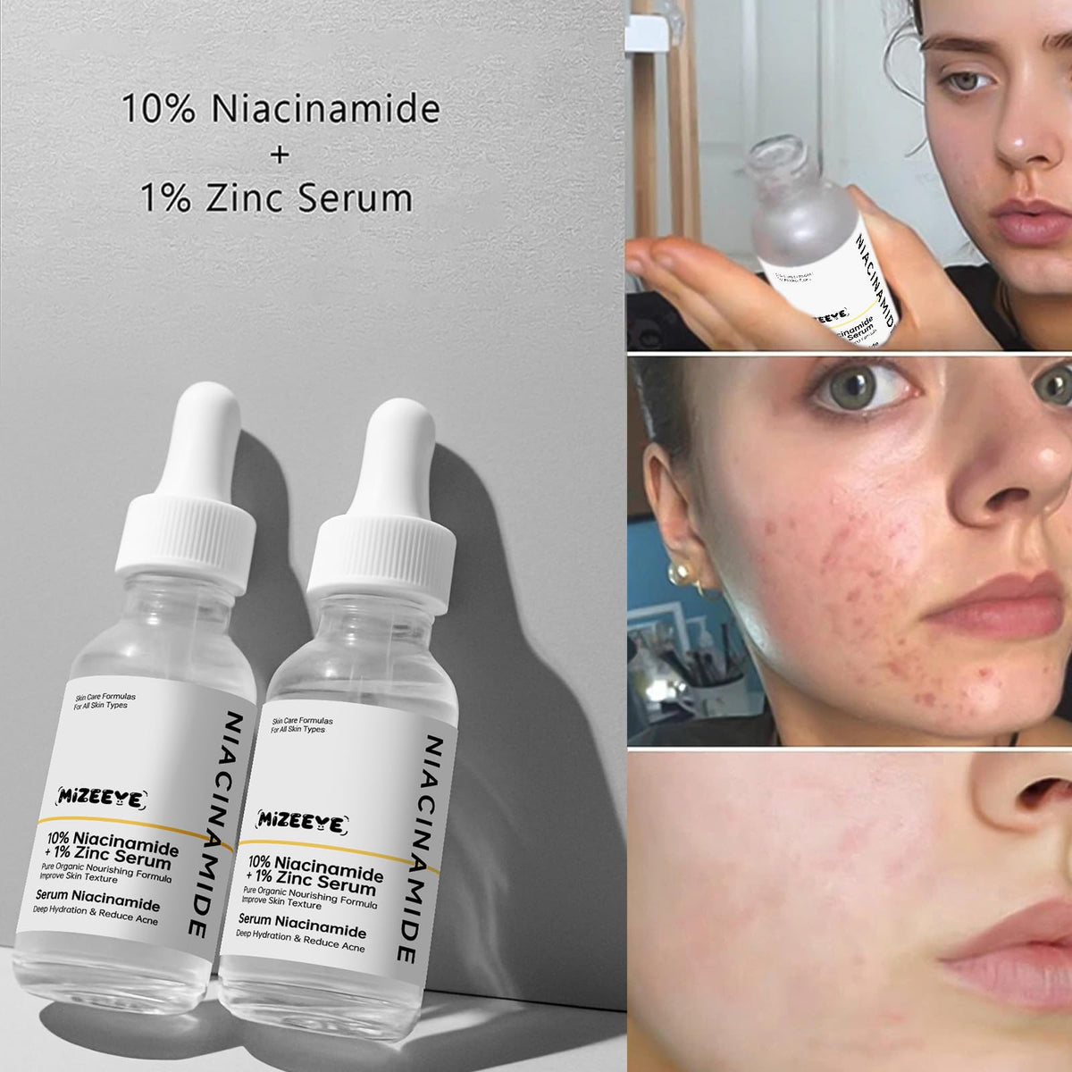 MIZEEYE Niacinamide Serum for Face, 2PCS Moisture Niacinamide Face Serum for Women, Niacinamide 10% + Zinc 1% Serum For Acne, Refreshing.