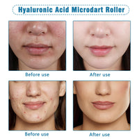 Nadiaen Micro Infusion System for Lips Face, Hyaluronic Acid Face Serum Micro Infusion, Micro Infusion Facial System, Hydrating Serum, Anti Aging Suitable for All Skin Types