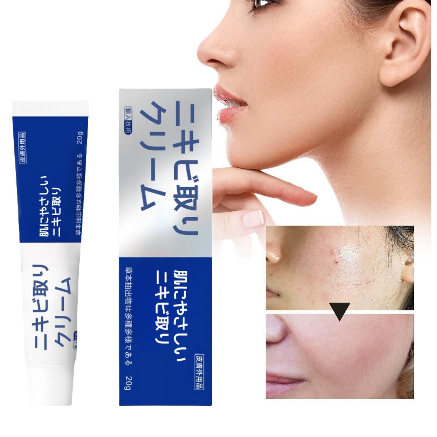 AINxtolm Acne Cream,Acne Treatment Cream,Japan Anti A/cne Treatment,Anti Ac/ne Face C/ream,Japanese Acn/e Cre/am,Face Ac/ne Treat/ment,Acn/e Treatm/ent Removal C/ream,Acne Treatme/nt Gel,Spot Treatmen/t
