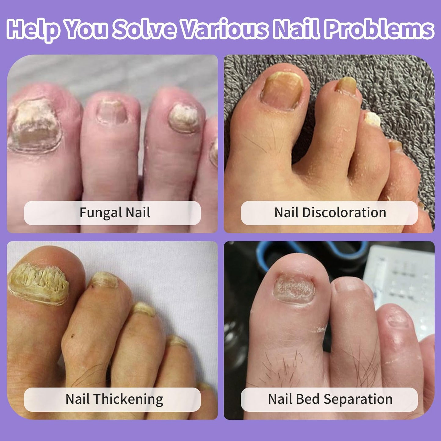HaSoCare Nail Fungus Device, Fungal Nail Treatment, Antigungal Device for Toenail Fingernail and Onychomycosis