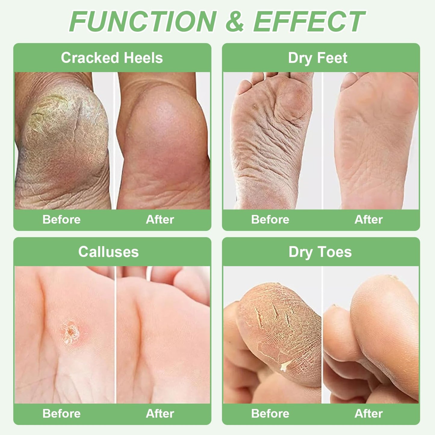 KAYZON Foot Peel Masks, 5 Pairs Feet Exfoliating Socks, Aloe Vera Foot Moisturiser Socks for Foot Care, Cracked Heel, Dead & Hard Skin, Foot Mask for Women & Men - Baby Soft Smooth Touch Feet