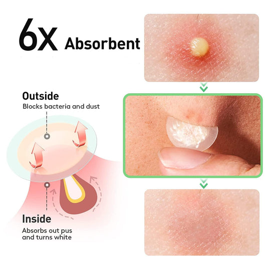 Zebrlan Pimple Patches 300 Counts Acne Patch Spot Patches Blemish Stickers Hydrocolloid Invisible Patches Spot Dots Acne Effectively Face Skin Care,4 Sizes