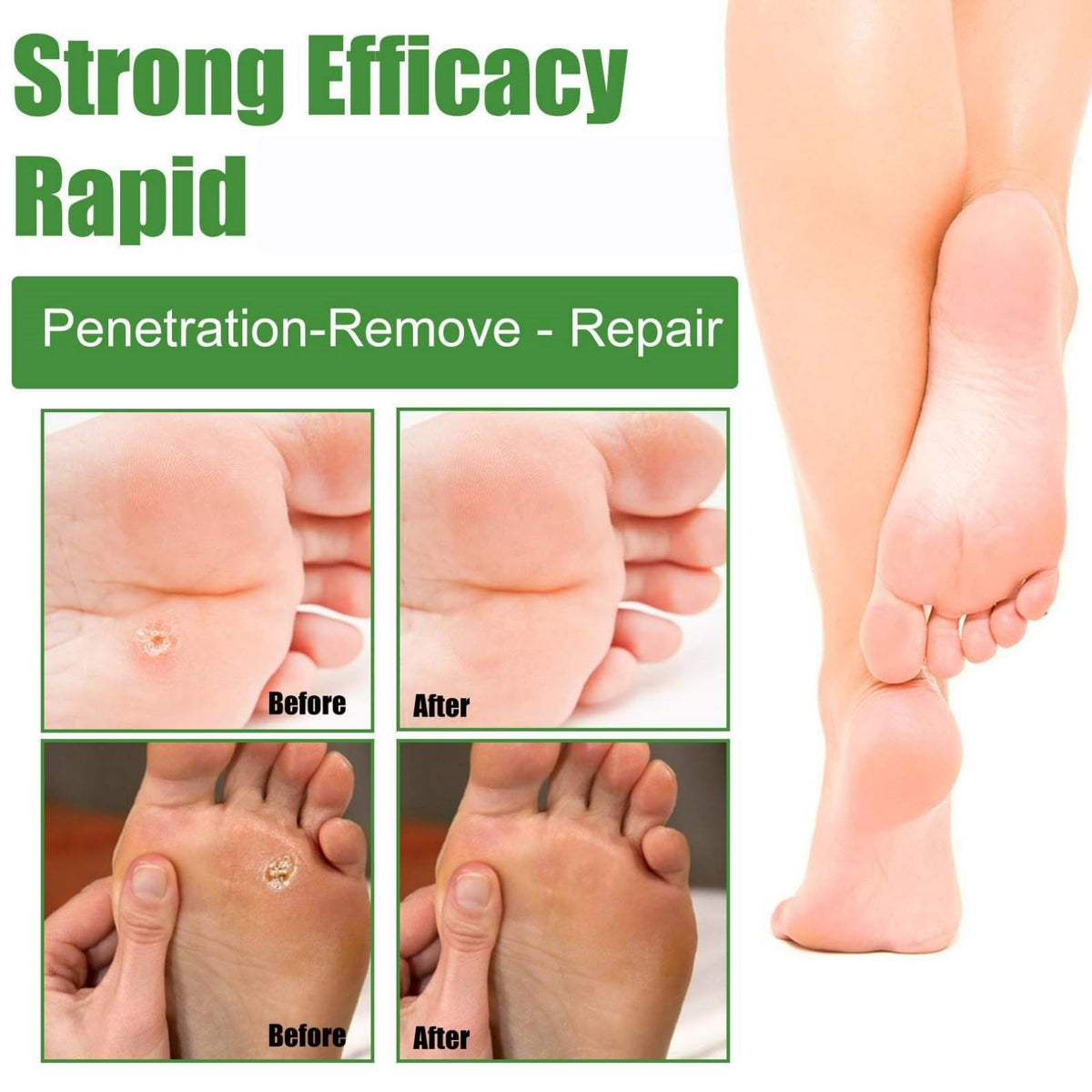 ChunBin 30PCS Verruca Treatment,Wart Treatment Patch,Wart Remover,Plantar Wart Remover for Hands,Pain Free Plasters for Adults,Stops Wart Regrowth,Repair Skin,Easy to Use,Non-Irritating Effective,Pain Relief