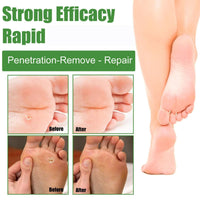 ChunBin 30PCS Verruca Treatment,Wart Treatment Patch,Wart Remover,Plantar Wart Remover for Hands,Pain Free Plasters for Adults,Stops Wart Regrowth,Repair Skin,Easy to Use,Non-Irritating Effective,Pain Relief