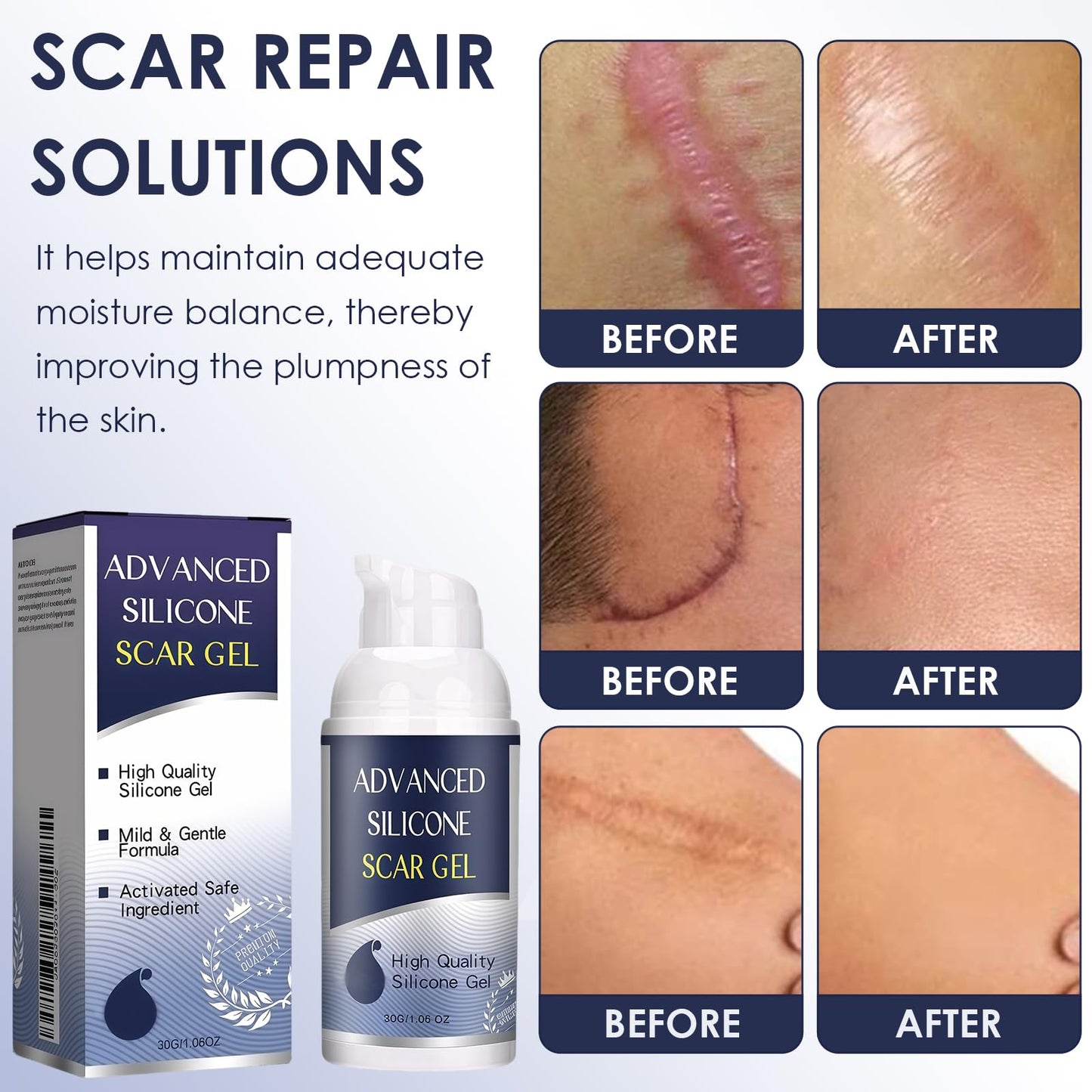 Uheltosly 30g Scar Gel, Scar Cream, Mild and Moisturizing Scar Removal Cream, Stretch Mark Cream, Recovery for Old and New Scars