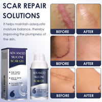 Uheltosly 30g Scar Gel, Scar Cream, Mild and Moisturizing Scar Removal Cream, Stretch Mark Cream, Recovery for Old and New Scars