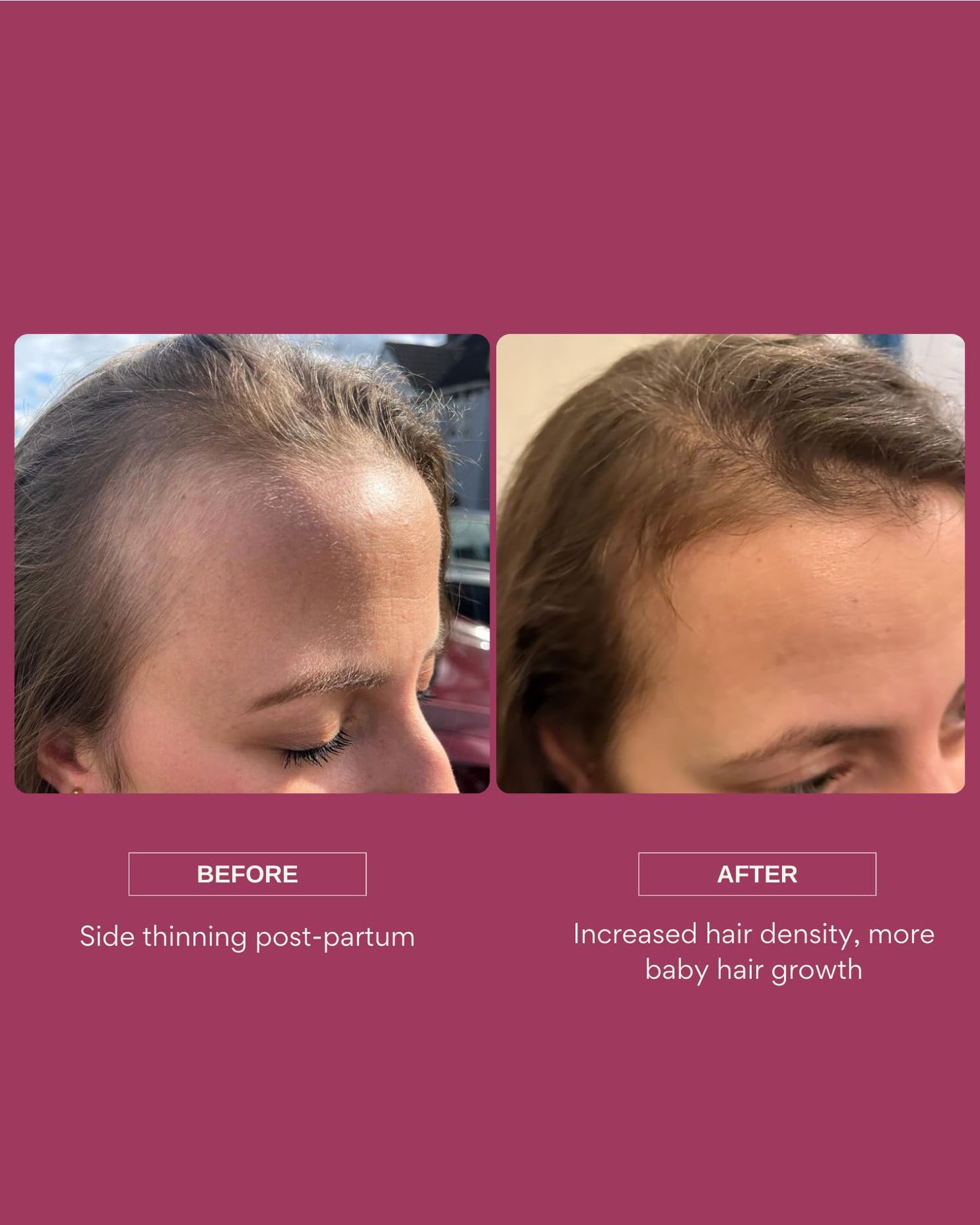 Resèt Hair Growth Serum, 50ml - Boosts Hair Growth, Targets Hair Loss & Thinning, with Caffeine, 4% AnaGain™, Probiotics, Results in 90 Days