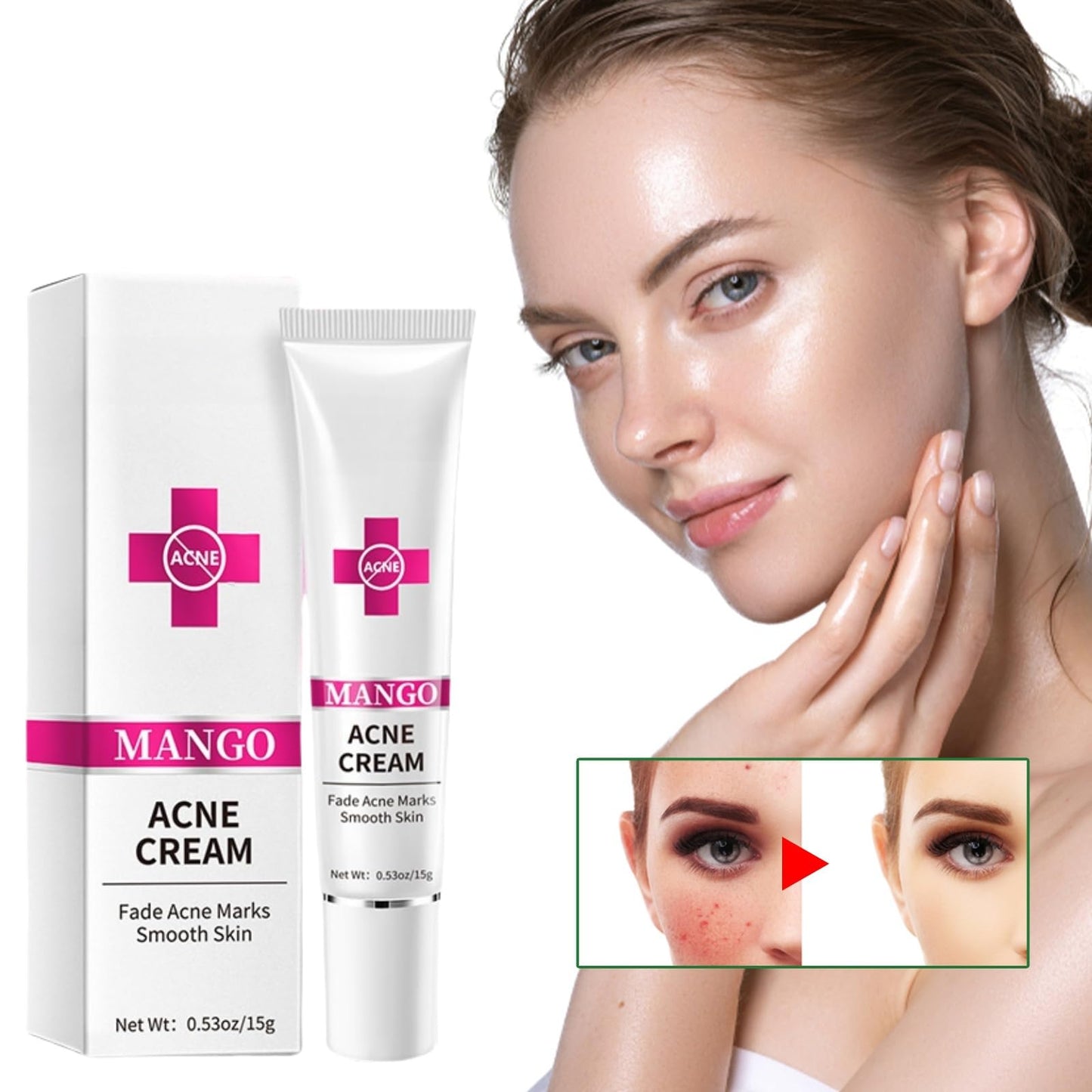 Xunzhi Acne Cream Pimple Cream for Face,Acne Treatment,Oil Control Pimple Remover Cr/eam,S/p/o/t Treatment,S/p/ot Crea/m,Acn/e Scar Treatm/ent,Anti Redness Crea/m for Face,Pim/ple Cre/am S/p/o/t Treatm/ent