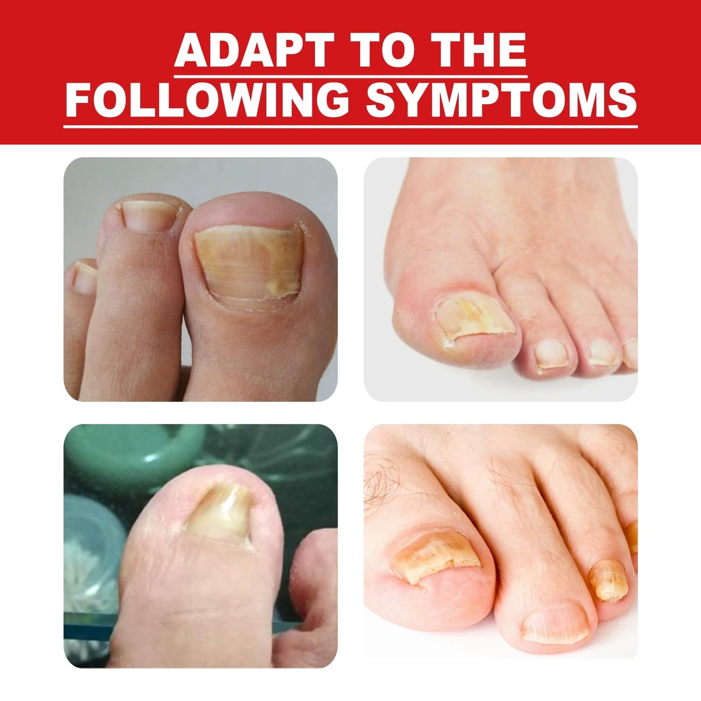 Fashion Base Ingrown Toenail Treatment Drop - Ingrown Toenail Treatment- Cuticle Care Oils for Ingrown Toenails - Trimming Toenail Softening Drops Natural Ingrown Toenail Correction Fungal Nail - 10ml