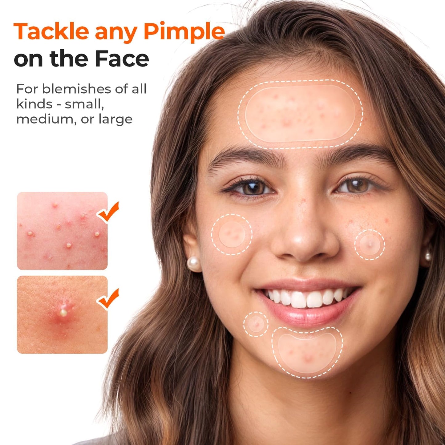 TKTK 443 Count Pimple Patches for Face, Hydrocolloid Spot Stickers, 5 Sizes
