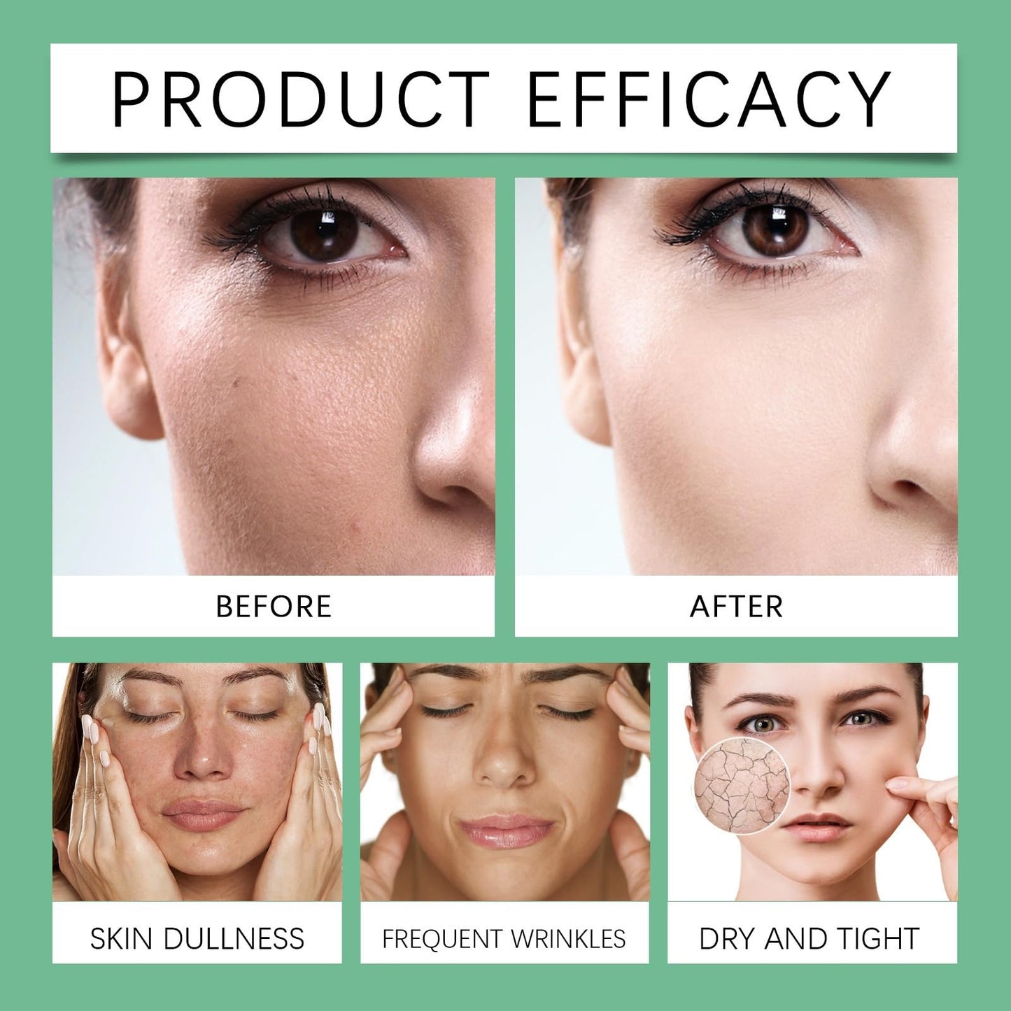 Oumun 10% Azlaic Acid Booster Cream Gel,Azlaic Acid Cream for Face,A/zlaic A/cid Cr/eam 10%,A-zlaic Ac-id Gel,Acne Treatment Cr-eam,Acne Cre-am,Skin Tightening Crea-m for Fa-ce,Azlai-c Aci-d Serum
