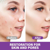 2Pcs Azelaic Acid The Ordinary, Azelaic Acid Serum, 12% Azelaic Acid Azelaic Acid 20% Cream Face Skin Care Pigmentation Treatment for All Skin Types