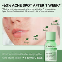 LANBENA Precision Acne Treatment Spot Serum, Drying Lotion, Overnight Acne Treatment For Face, Dry Out Pimples, Blemishes, Zits And Clean Pores, 0.42 Fl Oz (Pack of 1)