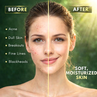 Moksha Tea Tree Acne Soap Bar Face & Body- Acne Blemish Spots Blackheads Cleanser